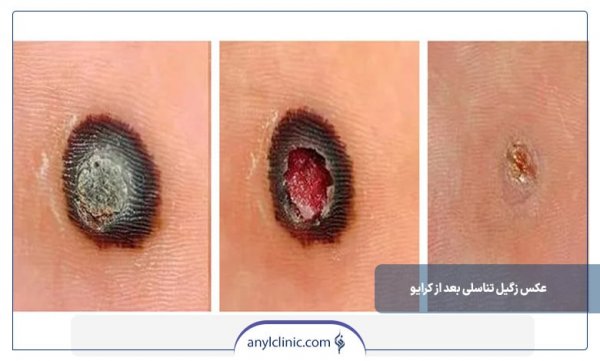  عکس زگیل تناسلی بعد از کرایو/کرایوتراپی