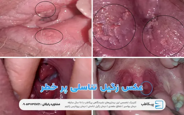  آیا بعد از درمان زگیل تناسلی میتوان باردار شد؟