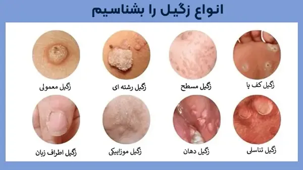  آیا بعد از درمان زگیل تناسلی میتوان باردار شد؟