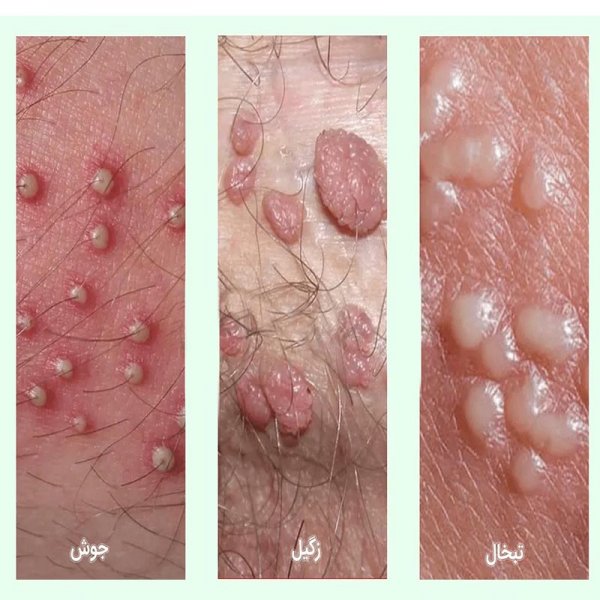  آیا بعد از درمان زگیل تناسلی میتوان باردار شد؟