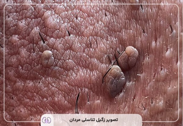  آیا زگیل تناسلی در مردان واگیردار است؟