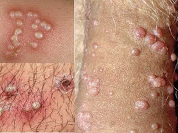  آیا زگیل تناسلی در مردان واگیردار است؟