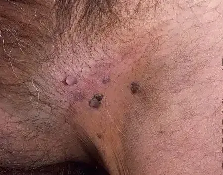  آیا زگیل تناسلی در مردان واگیردار است؟