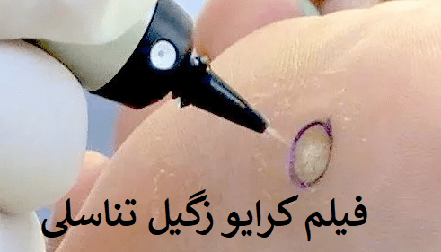 فرق کرایو زگیل تناسلی با فریز زگیل تناسلی در چیست؟