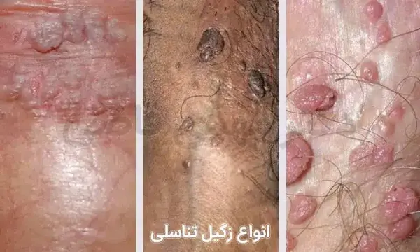  فرق کرایو زگیل تناسلی با فریز زگیل تناسلی در چیست؟