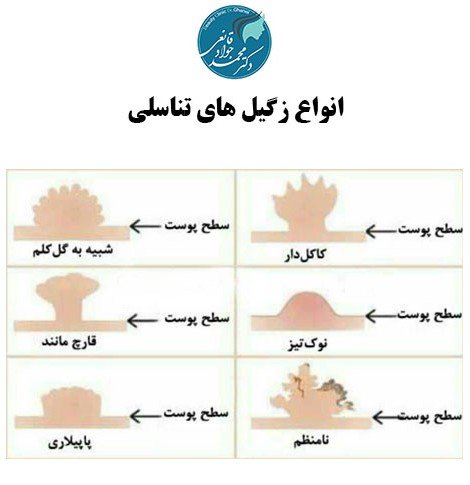 فرق کرایو زگیل تناسلی با فریز زگیل تناسلی در چیست؟
