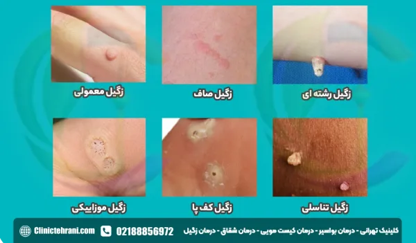  فرق کرایو زگیل تناسلی با فریز زگیل تناسلی در چیست؟