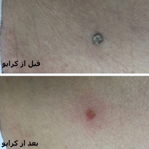  فرق کرایو زگیل تناسلی با فریز زگیل تناسلی در چیست؟