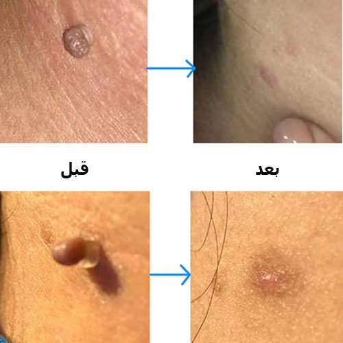  فرق کرایو زگیل تناسلی با فریز زگیل تناسلی در چیست؟