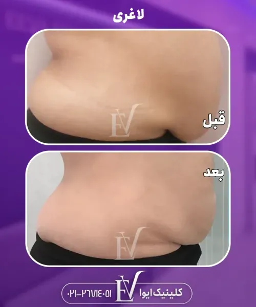  فیلم لاغری با کرایولیپولیز