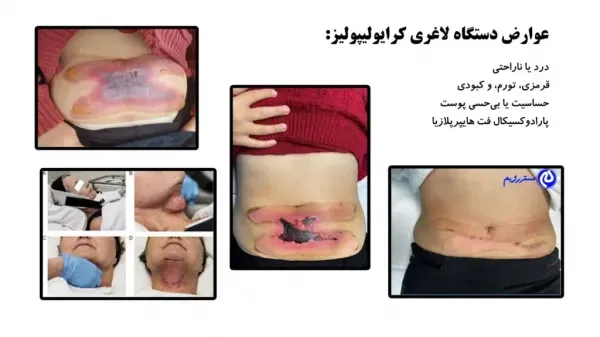  فیلم لاغری با کرایولیپولیز