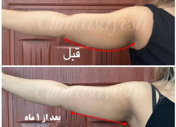  فیلم لاغری با کرایولیپولیز