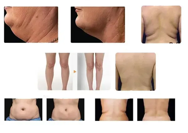  فیلم لاغری با کرایولیپولیز