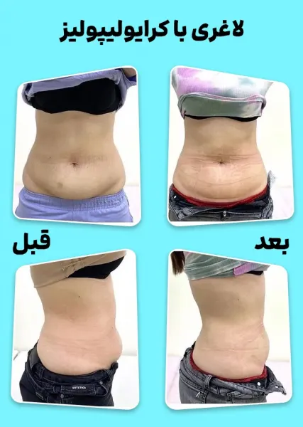 من کرایولیپولیز انجام دادم!