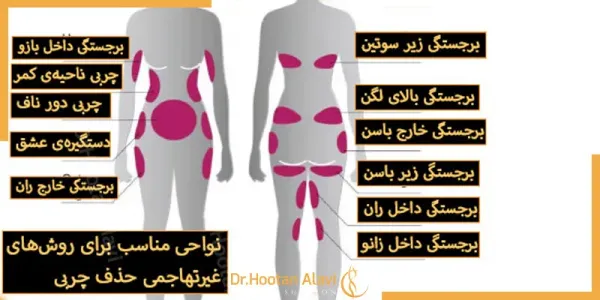  من کرایولیپولیز انجام دادم!