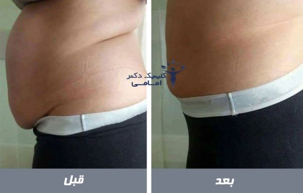  من کرایولیپولیز انجام دادم!