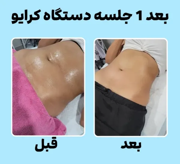  من کرایولیپولیز انجام دادم!