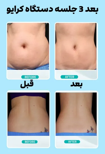  من کرایولیپولیز انجام دادم!