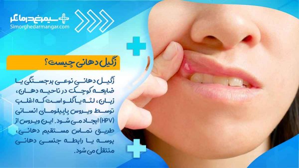  عکس زگیل دهانی خفیف