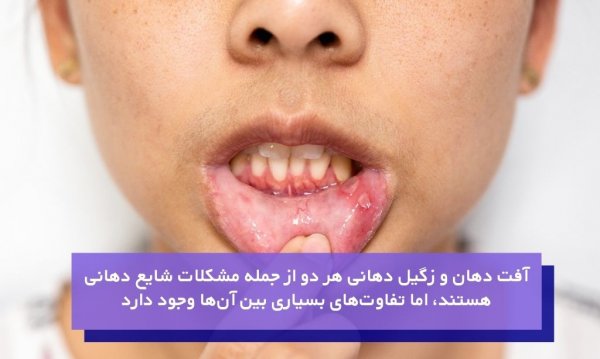  عکس زگیل دهانی خفیف