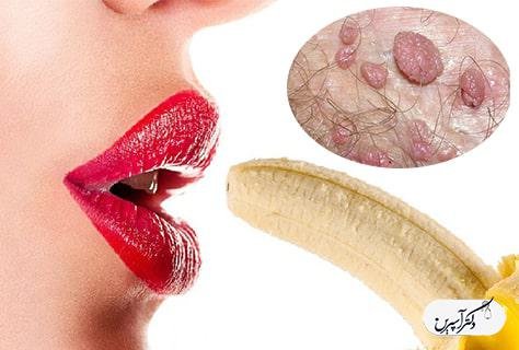  بهترین قرص برای زگیل دهانی