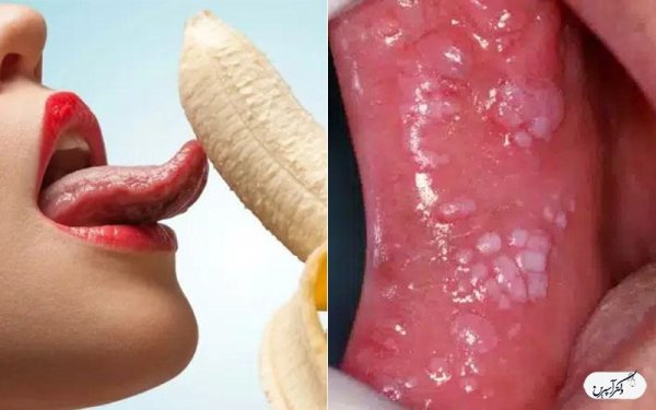  بهترین قرص برای زگیل دهانی