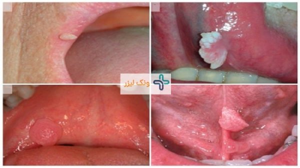  بهترین قرص برای زگیل دهانی