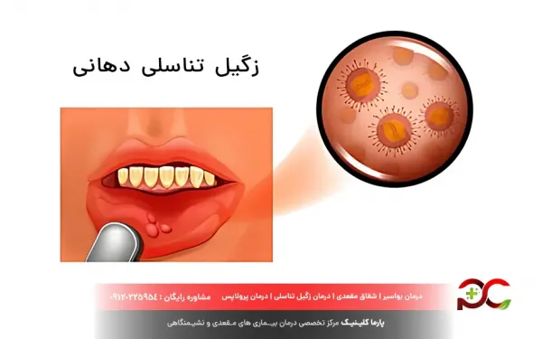  بهترین قرص برای زگیل دهانی