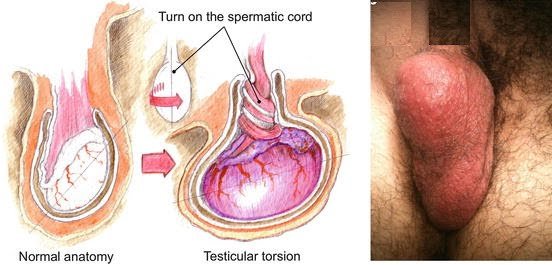  درد بیضه به دلیل نداشتن رابطه جنسی