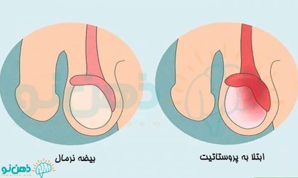  درد بیضه به دلیل نداشتن رابطه جنسی