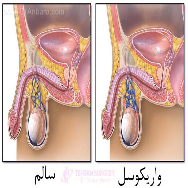  آیا بعد از عمل واریکوسل اسپرم قوی میشود؟