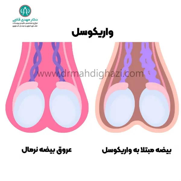 آیا بعد از عمل واریکوسل اسپرم قوی میشود؟
