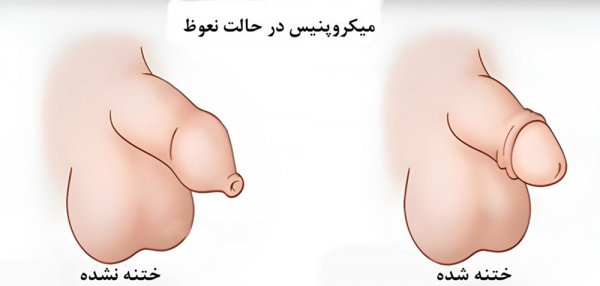  درمان کوچک بودن اندام تناسلی نوجوانان