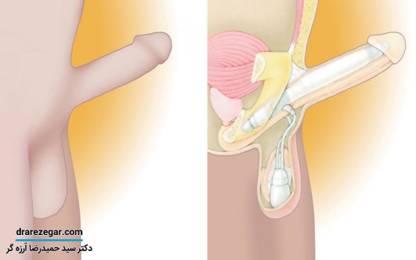  قیمت عمل جراحی دستگاه تناسلی مردان