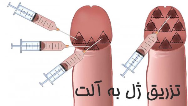 عوارض تزریق ژل به اندام تناسلی مردان+تجربه مردان از تزریق ژل به آلت