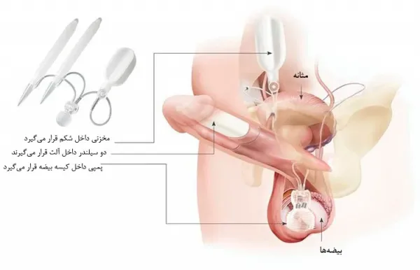  عوارض تزریق ژل به اندام تناسلی مردان+تجربه مردان از تزریق ژل به آلت