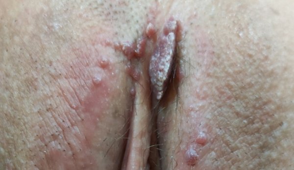  عکس زخم بیرونی واژن