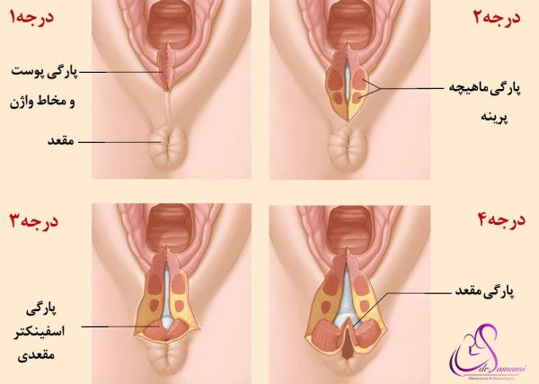  پارگی واژن در اثر رابطه جنسی/سکس