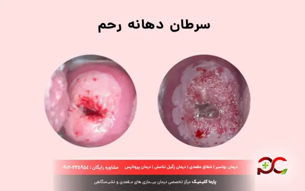  پارگی واژن در اثر رابطه جنسی/سکس