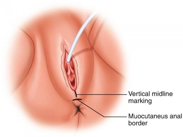  پارگی واژن در اثر رابطه جنسی/سکس