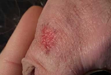 عکس زخم دستگاه تناسلی مردان