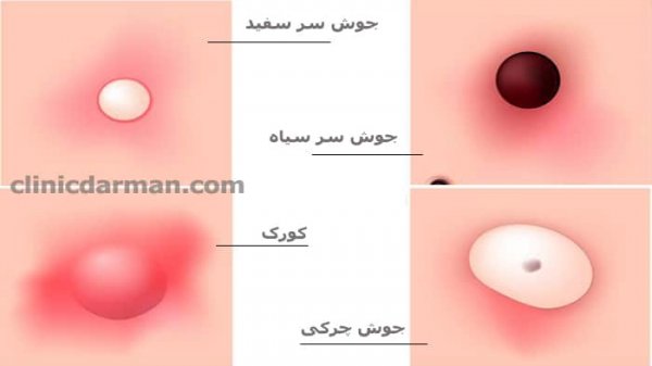  عکس زخم دستگاه تناسلی مردان