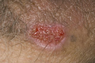  عکس زخم دستگاه تناسلی مردان