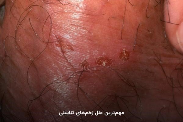  عکس زخم دستگاه تناسلی مردان