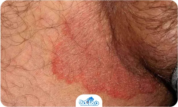  عکس زخم دستگاه تناسلی مردان