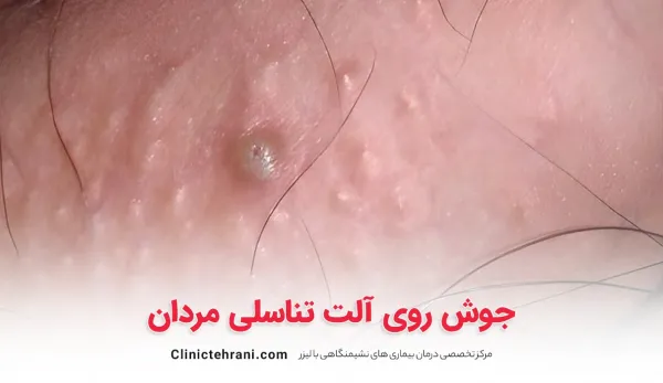  عکس زخم دستگاه تناسلی مردان