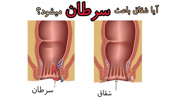  درمان شقاق واژینال+درمان شقاق مقعدی