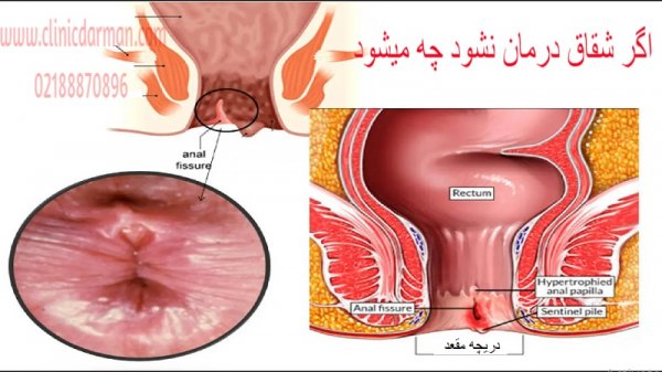  درمان شقاق واژینال+درمان شقاق مقعدی
