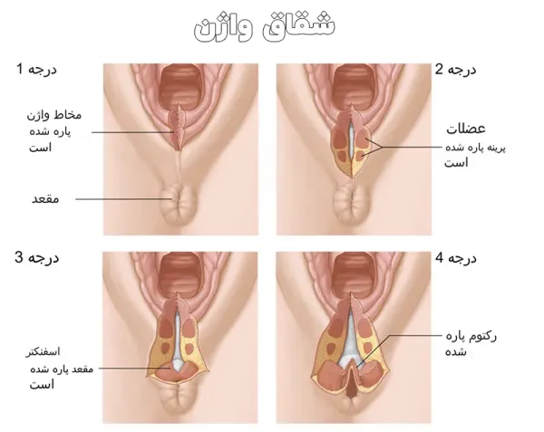  درمان شقاق واژینال+درمان شقاق مقعدی
