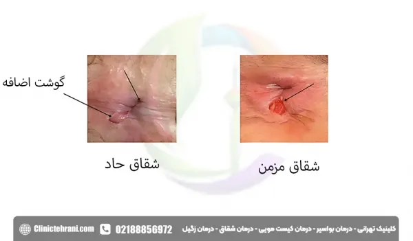  درمان شقاق واژینال+درمان شقاق مقعدی